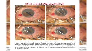 Endothelial keratoplasty DMEK DSEK DLEK PDEK Ophthalmology [upl. by Hosfmann]