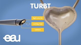 Bladder cancer treatment TURBT [upl. by Yeclehc142]