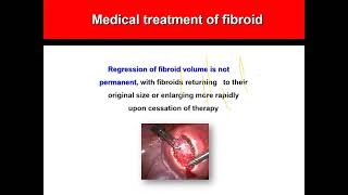 Fibroid All about management [upl. by Enoch]