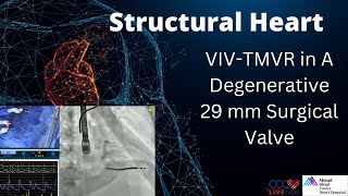 VIVTMVR in A Degenerative 29 mm Surgical Valve [upl. by Beret754]