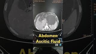 Abdomen ascitic fluid abdomen abdomenascitic shorts viralshorts [upl. by Tiram372]