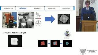 Efficacité du Laser Thulium fibré pour la lithotripsie endocorporelle et planification chirurgicale [upl. by Etnoval]