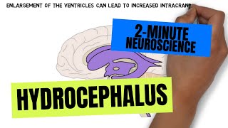 2Minute Neuroscience Hydrocephalus [upl. by Langbehn]