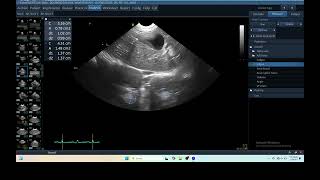 IQ 229 TFAST LUNG ULTRASOUND ECHOPAC ANALYSIS [upl. by Fritzsche422]