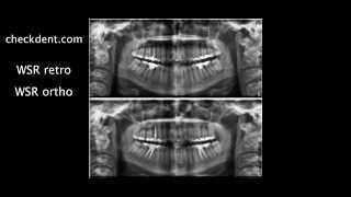 Wurzelspitzenresektion versus Endodontie [upl. by Ahsiela]