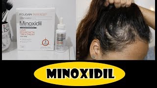 MINOXIDIL  Resultado em 3 meses Foligain [upl. by Naus]