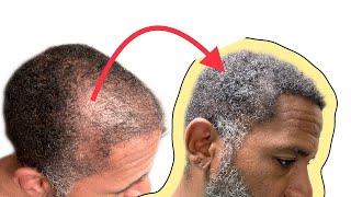 MY ASLI TARCAN REVIEW 9 MONTH POST OP HAIR TRANSPLANT [upl. by Ber151]