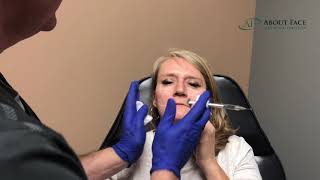 Juvederm Voluma Treatment Video [upl. by Barnie]