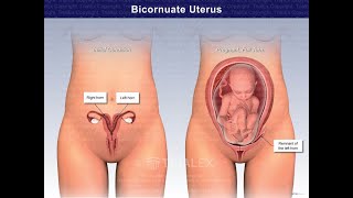 Bicornuate Uterus Symptoms and Causes  Diagnosis  Treatment  Prevention [upl. by Gunner]