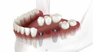 Fogpótlások fogászati implantátumra helyezve [upl. by Eiramrebma677]
