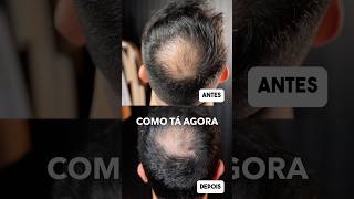 1 mês com Minoxidil para calvície 🔥 Ex Calvo [upl. by Rimidalb907]