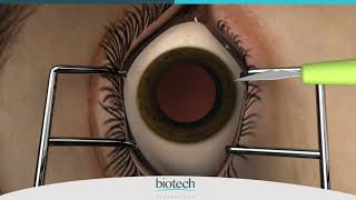 Eyecryl PHAKIC IOL Range Loading amp Implantation [upl. by Daphene]