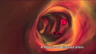 What is atherosclerosis [upl. by Som]