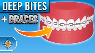 How Do Braces Fix Deep Bites  Premier Orthodontics [upl. by Spillihp]