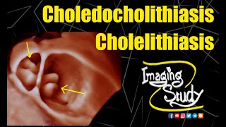 Cholelithiasis with Choledocholithiasis  Ultrasound  3D  Case 299 [upl. by Lahcym]