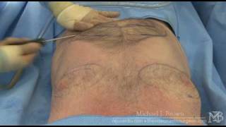 Ultrasonic liposuction of a mans chest and abdomen [upl. by Yodlem598]