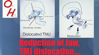 How to reduce a Temporomandibular TMJ Jaw dislocation [upl. by Xenos]