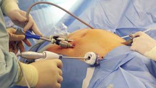 What are the advantages of a robotic surgery [upl. by Maighdlin112]