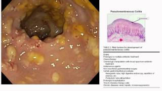 pseudomembranous colitis [upl. by Tacy]