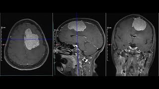 Middle One Third Parasagittal Meningioma Dr Akshay Vijay Kulkarni MCh Neurosurgery [upl. by Lerred937]