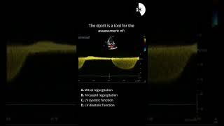 Echocardiography board practice question 29 [upl. by Pry773]