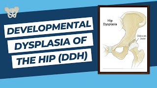 Developmental Dysplasia of the Hip DDH  FRCS Exam Review Orthopaedic Academy [upl. by Amii909]