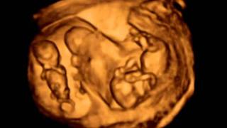 3D ultrasound Dichorionic triamniotic triplets 12 weeks [upl. by Id]