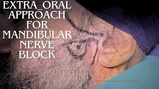 Extraoral Technique for Mandibular Nerve Block [upl. by Hazeghi927]