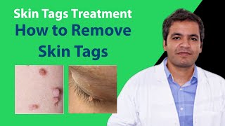 Skin Tags Removal Treatment  Reason for Skin Tags  Remove Skin Tags of Neck  DPN Removal [upl. by Roxane]