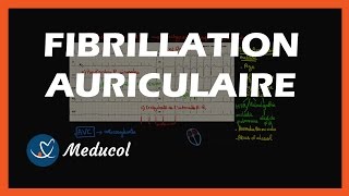 La Fibrillation Auriculaire Définition et Symptômes [upl. by Rebecka]