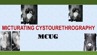 Micturating Cystourethrography MCUG [upl. by Arocat825]