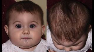 Metopic craniosynostosis before  after FOA Cranial vault remodeling  reshaping forehead eyes [upl. by Asilla]