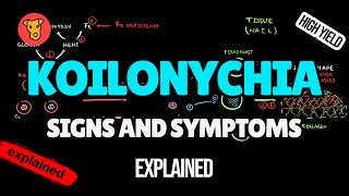 KOILONYCHIA Pathogenesis of Signs and Symptoms in Medicine [upl. by Nesnah213]