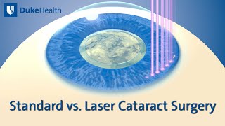 Standard vs Laser Cataract Surgery  Duke Health [upl. by Ker]