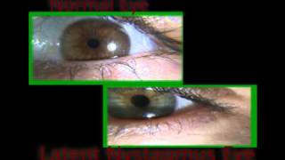 Comparison Latent Nystagmus VS Normal Eye [upl. by Nerrak]