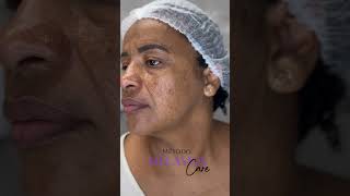 Tratamento personalizado para melasma [upl. by Khudari]