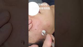 리팟 레이저 다발성 흑자 세종리팟 세종시리팟 reepot lentigo multiplelentigo 청주리팟 공주리팟 대전리팟 오창리팟 오송리팟 부여리팟 [upl. by Arst]