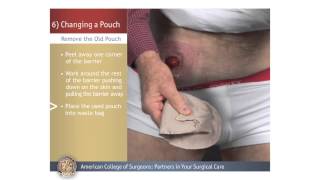 ColostomyIleostomy Changing a Pouch [upl. by Eesyak]