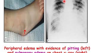 Treatment of congestive heart failure [upl. by Mandi154]