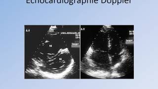 CARDIOLOGIE CAT devant une Embolie Pulmonaire [upl. by Tirrag]