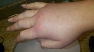 Difference Between Urticaria and Angioedema [upl. by Yerdna949]