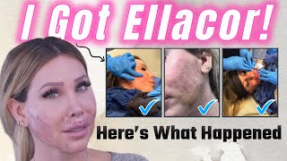 My quotNon Surgical Face Liftquot Experience  ELLACOR MicroCoring [upl. by Namwen485]