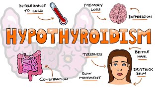 Hypothyroidism Signs and Symptoms Mnemonic  MOMS SO TIRED [upl. by Hoag]