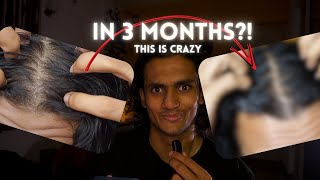 23 Year old Indian takes Finasteride  Part2 [upl. by Blaze]