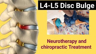 L4L5 disc bulge annular Tear treatmentchiropractic Treatment for back painneurotherapy treatment [upl. by Odlawso]