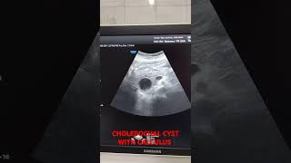 CHOLEDOCHAL CYST WITH CALCULUS usg radiodiagnosis [upl. by Turino]