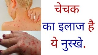 चेचक का इलाज है ये नुस्खे Home remedies for smallpox chechak ke daag ka ilaj in hindi [upl. by Nerland64]