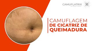 Caso Clínico Camuflagem de CICATRIZ DE QUEIMADURA  LUCAS CASTRO  CAMUFLATRIX [upl. by Thibault751]