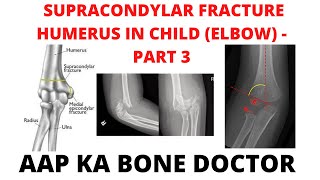 SUPRACONDYLAR FRACTURE HUMERUS IN A CHILD ELBOW  PART 3 EPISODE 29 [upl. by Worden]