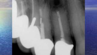 Fistula Could Trick You  Three Endodontic Cases [upl. by Alvita]